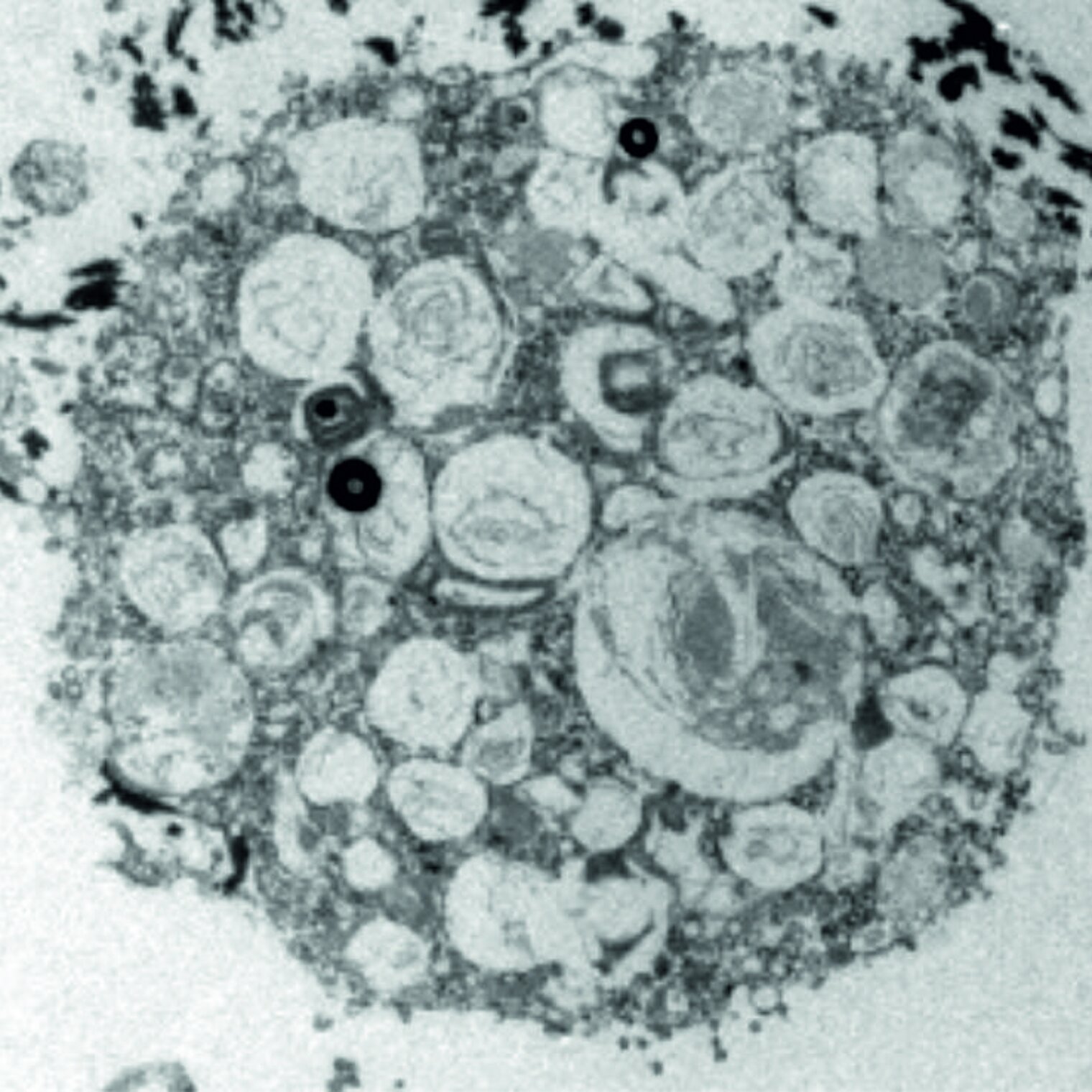 microscopic image of a foamy cell from a lung affected by COVID-19