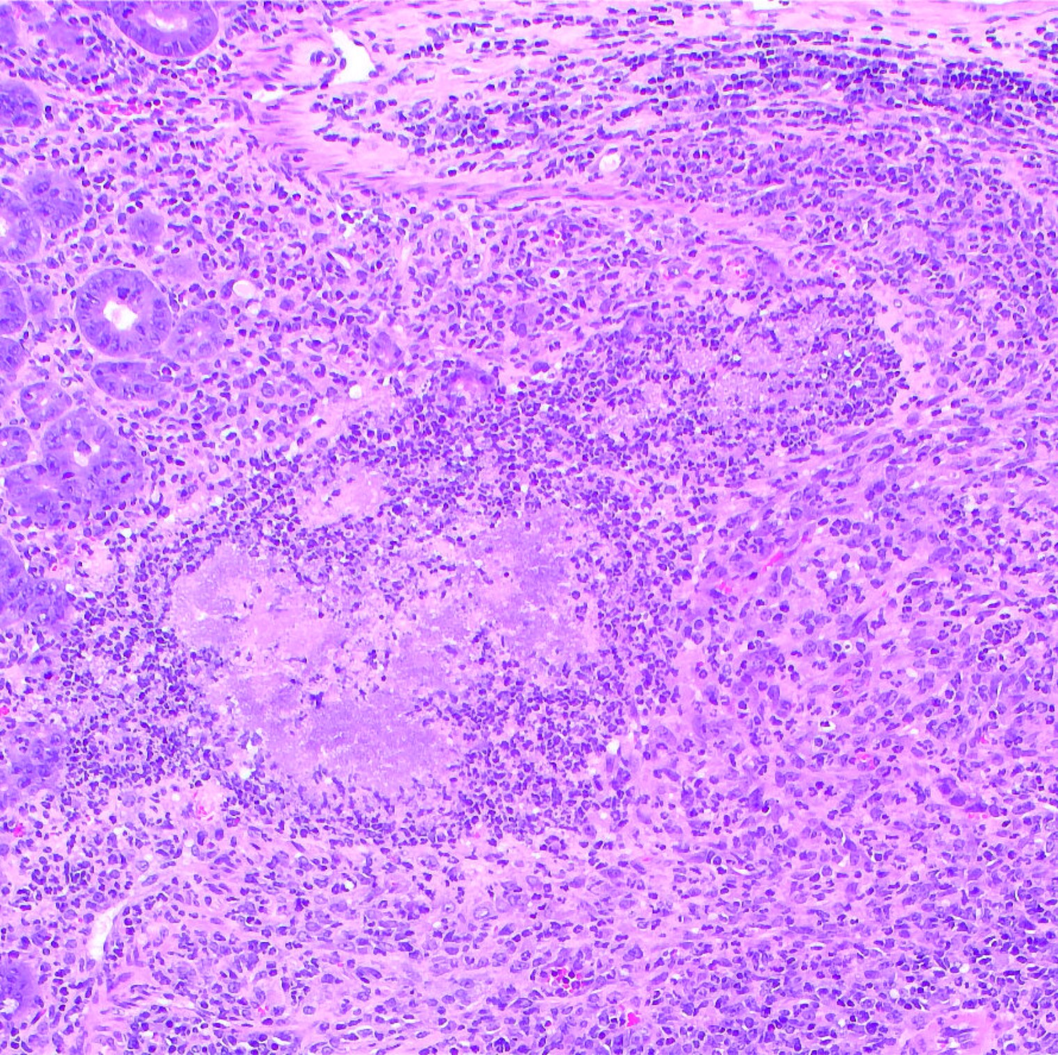 microscopic image of a granuloma in the cecum following infection with Yersinia pseudotuberculosis