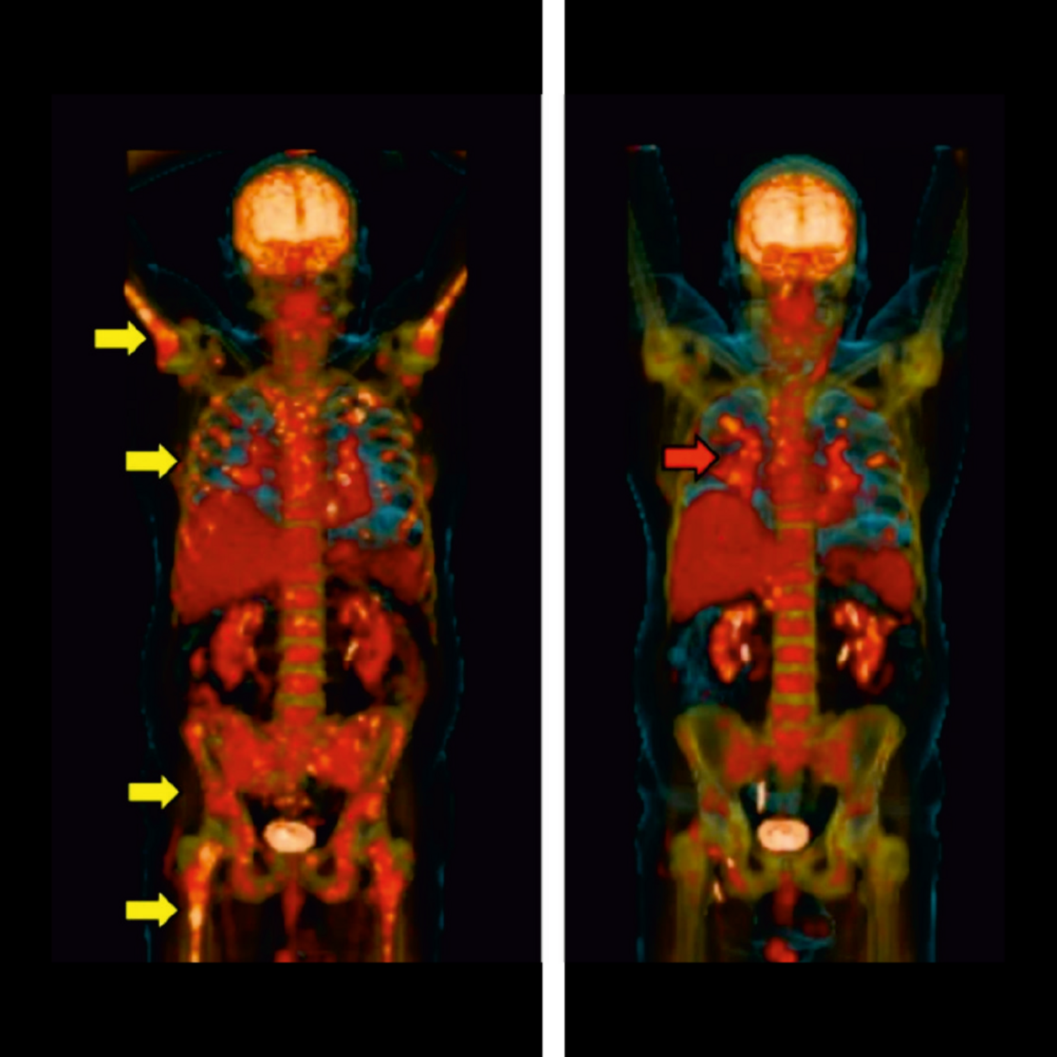Lung sarcoidosis